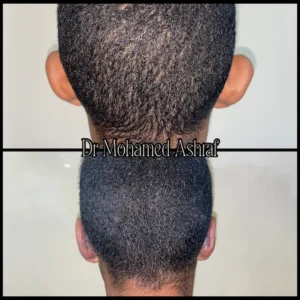 تكلفة عملية الاذن الخفاشية في مصر