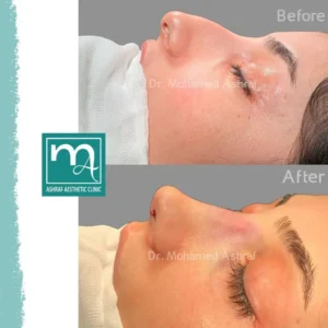 تجميل الانف 2026