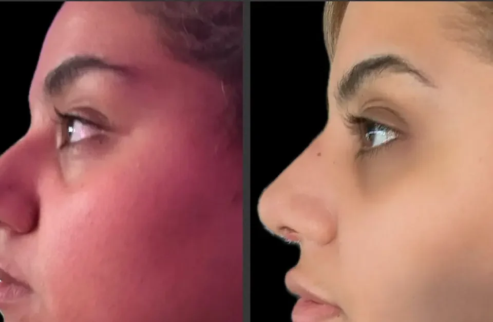 سعر عملية تجميل الانف في مصر