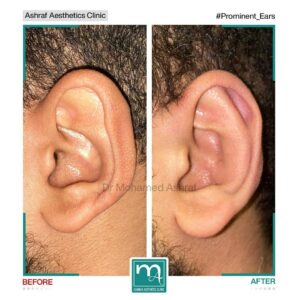 عملية تجميل الأذن