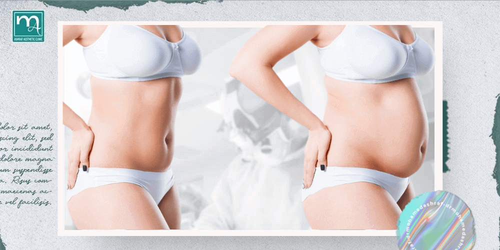 Mommy Makeover: Tummy Tuck - Regain Your Pre-Baby Figure