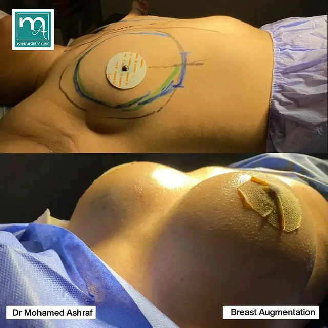 عملية تكبير الثدي