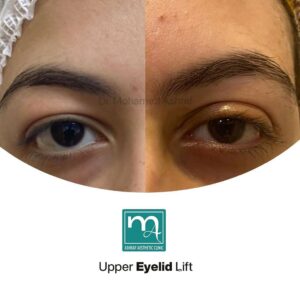 Eyelid lift Surgery
