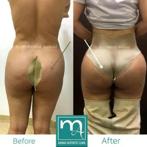 عملية شد وتجميل الارداف