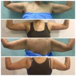 Arms lift surgery results