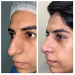 Male Rhinoplasty - Hump reduction and tip elevation