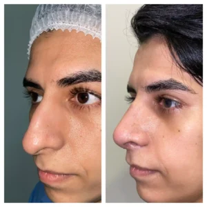 Rhinoplasty