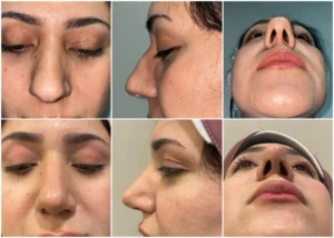 Deviated nose correction with hump reduction and tip elevation rhinoplasty