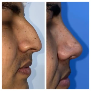 Male rhinoplasty - hump reduction to straighten the dorsum