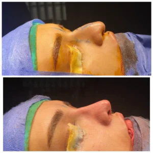 Tip elevation, hump reduction rhinoplaty