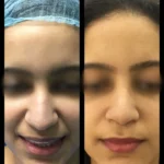rhinoplasty front view - nose shortening