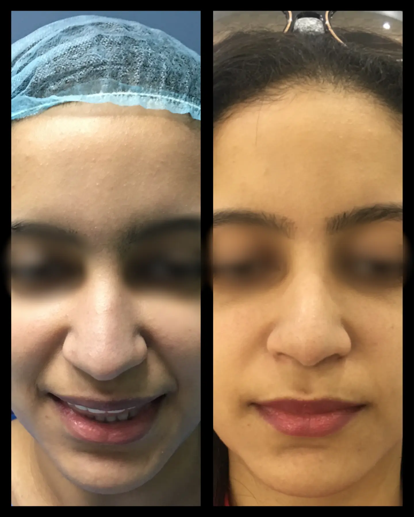 rhinoplasty front view - nose shortening