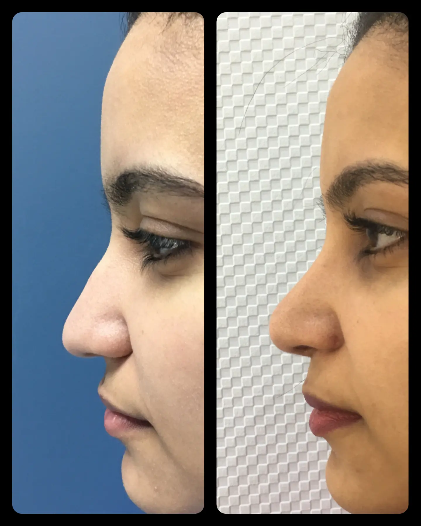 Side view - Nose shortening 