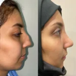 Hump reduction and tip elevation rhinoplasty