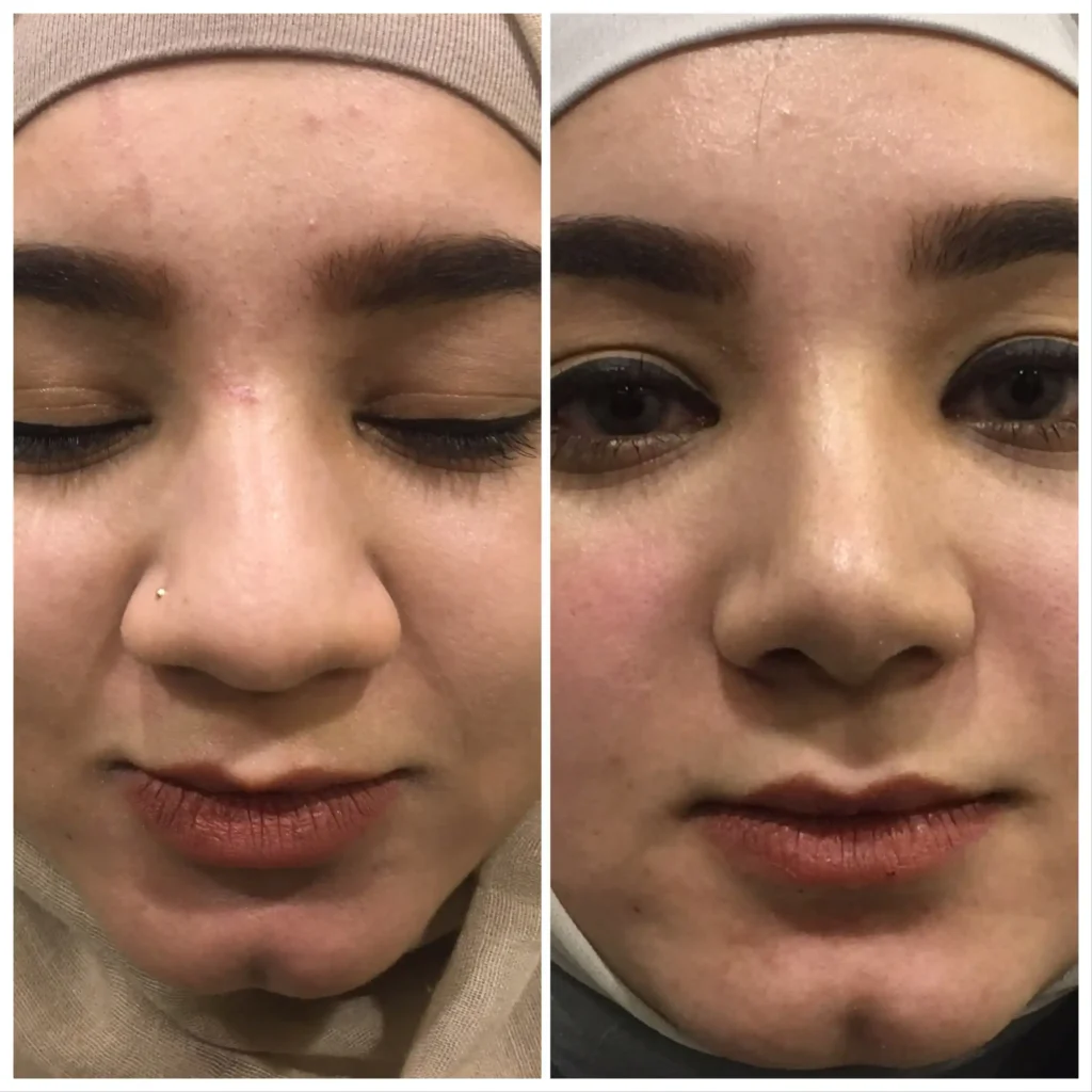 Rhinoplasty - before and after