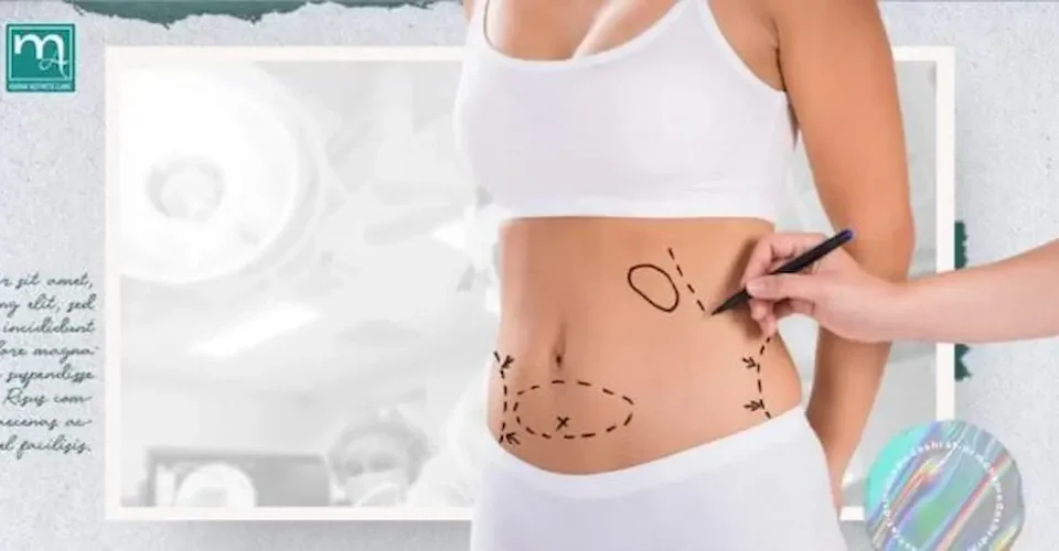 أسئلة شائعة حول عمليات شد البطن