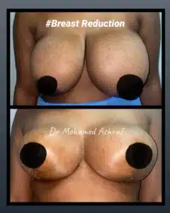 Breast reduction
