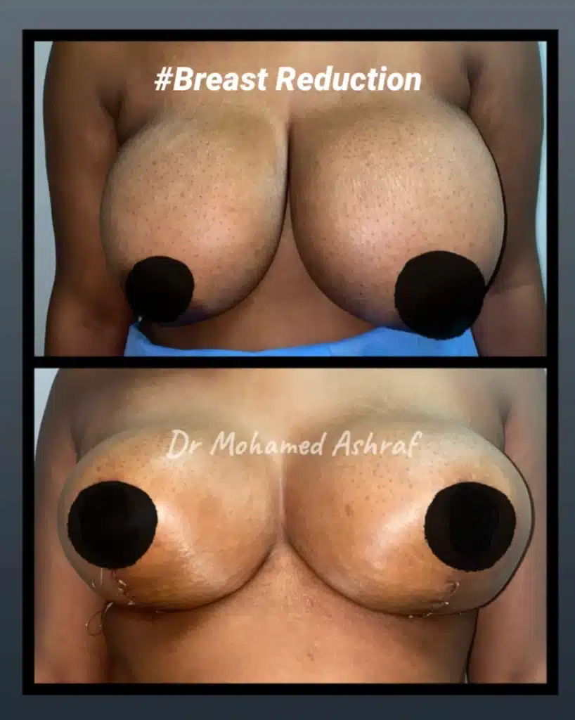 Breast reduction in Egypt before and after photo