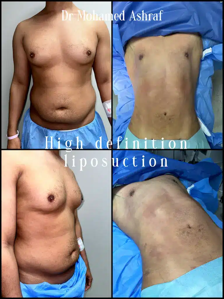 high definition body liposuction for a man