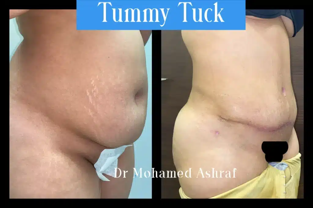 Tummy tuck with liposuction