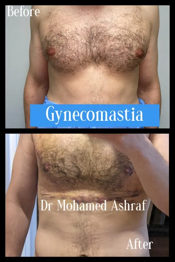 Gynecomastia Egypt