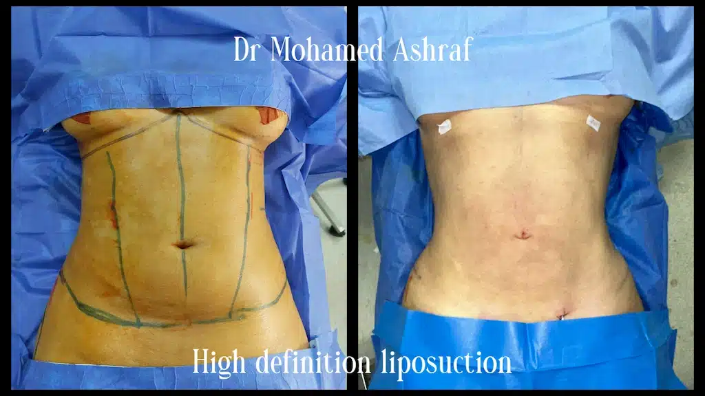 high definition vaser liposuction before and after 