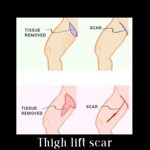 thigh lift scar