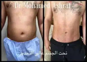 نحت الجسم عالي التحديد في مصر