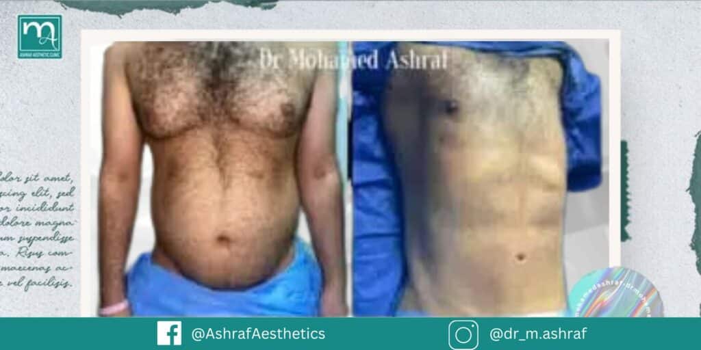 نحت الجسم للرجال قبل وبعد