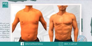 نحت الجسم للرجال قبل وبعد