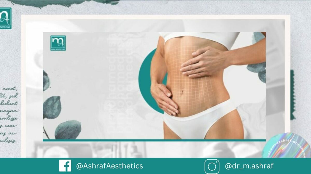 عملية شد البطن