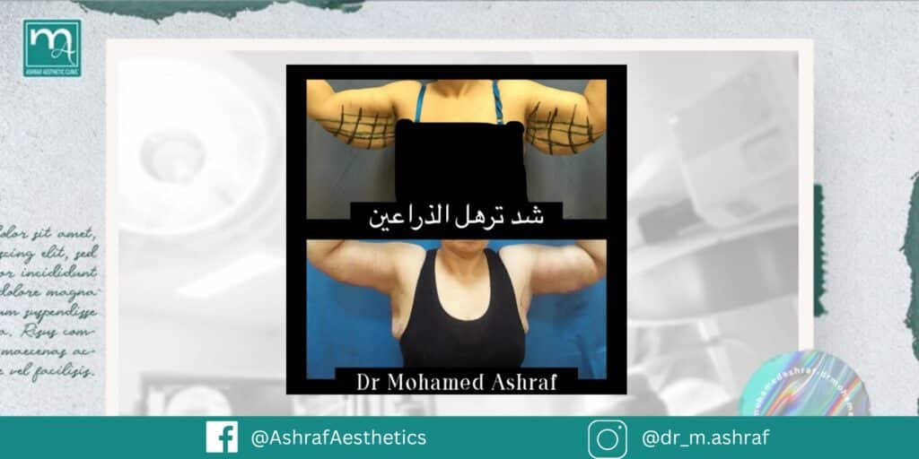 فترة النقاهة بعد عملية شد الذراعين