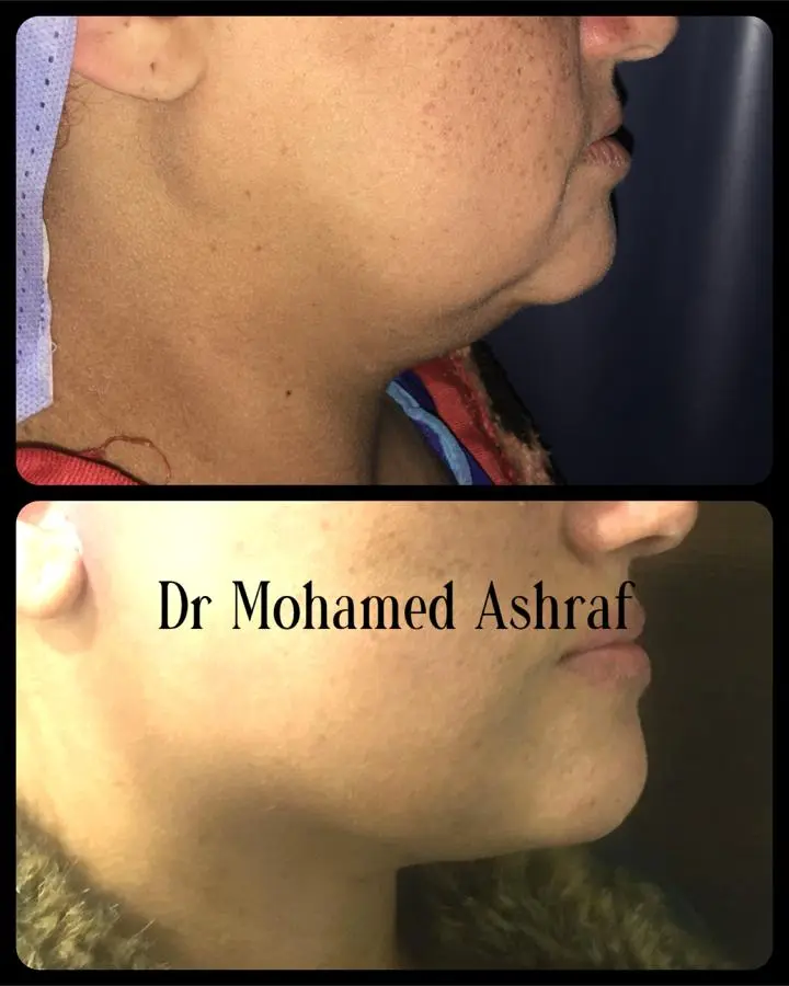 Double chin liposuction