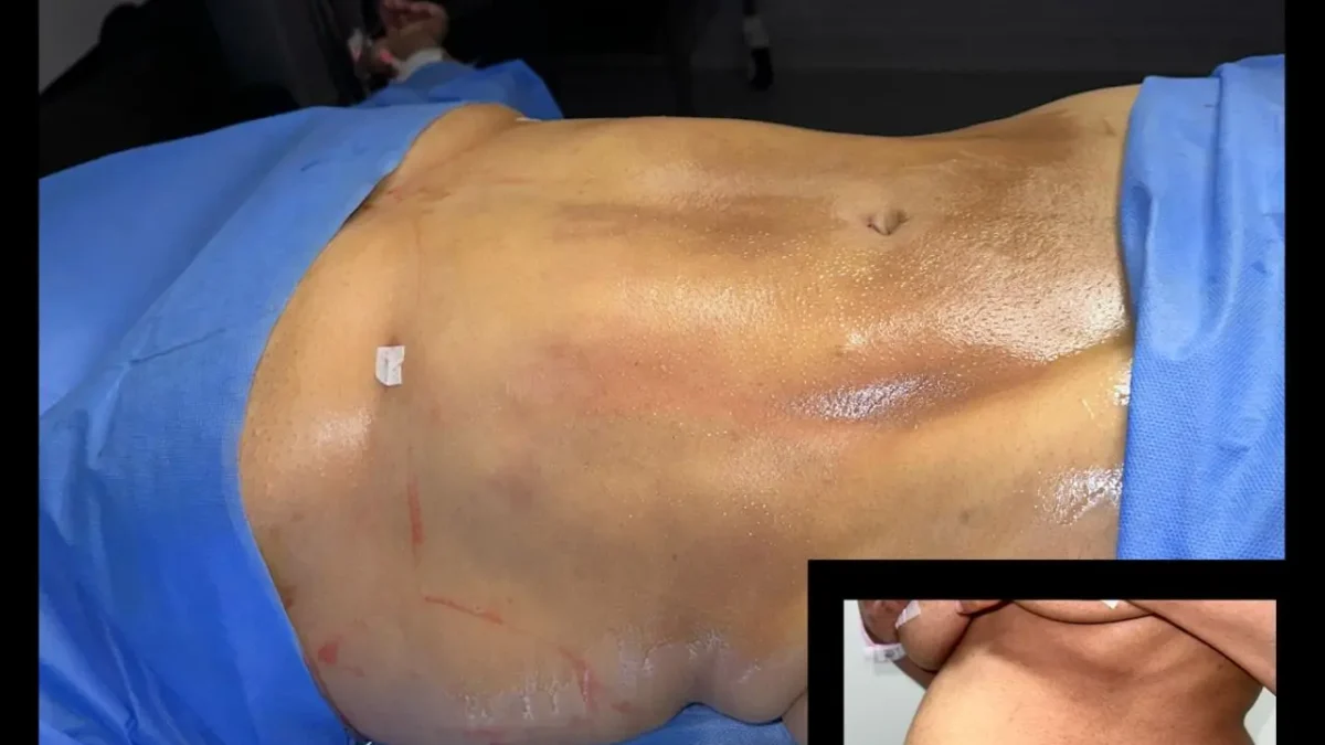 Liposuction in Egypt
