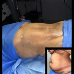 Liposuction in Egypt
