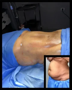 Liposuction in Egypt