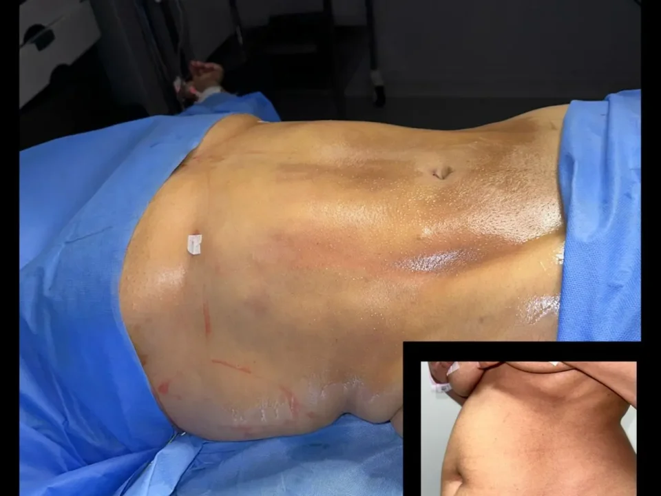 Liposuction in Egypt