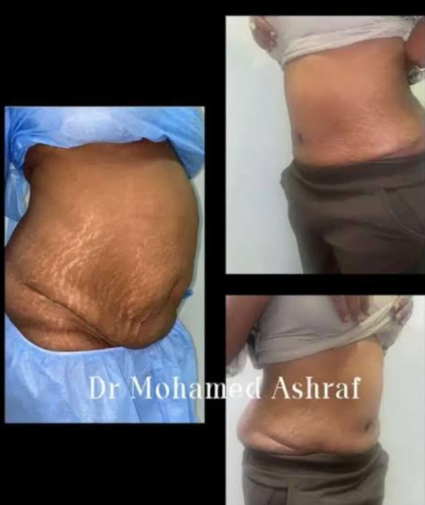 شد ترهلات البطن