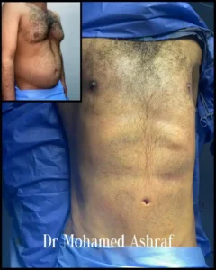 Hi-Def VASER® liposuction
