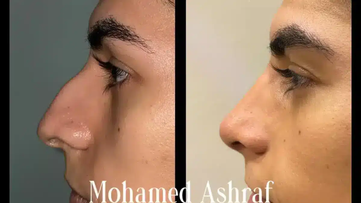 Male Nose job - before and after