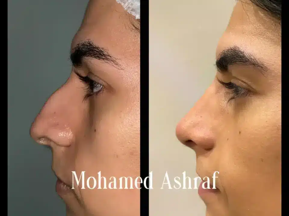 Male Nose job - before and after