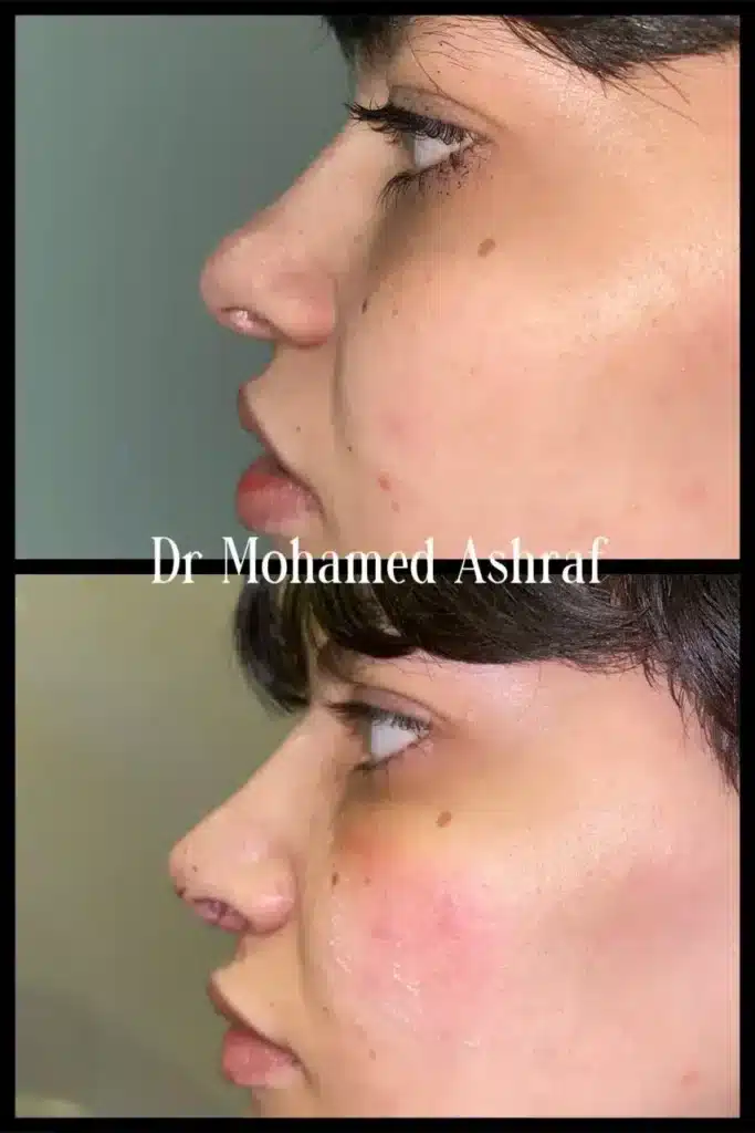 Nose job in Egypt