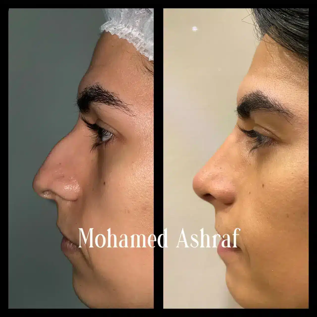 How much does a Nose job cost in Cairo or Egypt? Dr M. Ashraf