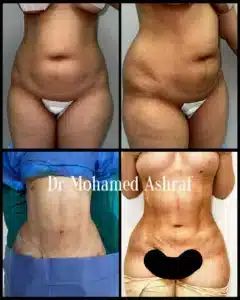 vaser lipo before and after