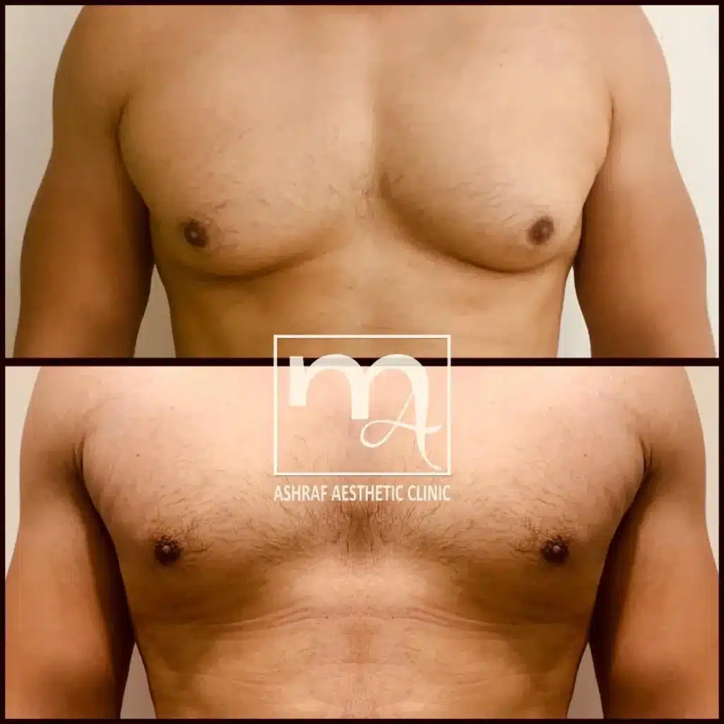 Gynecomastia Surgery Egypt