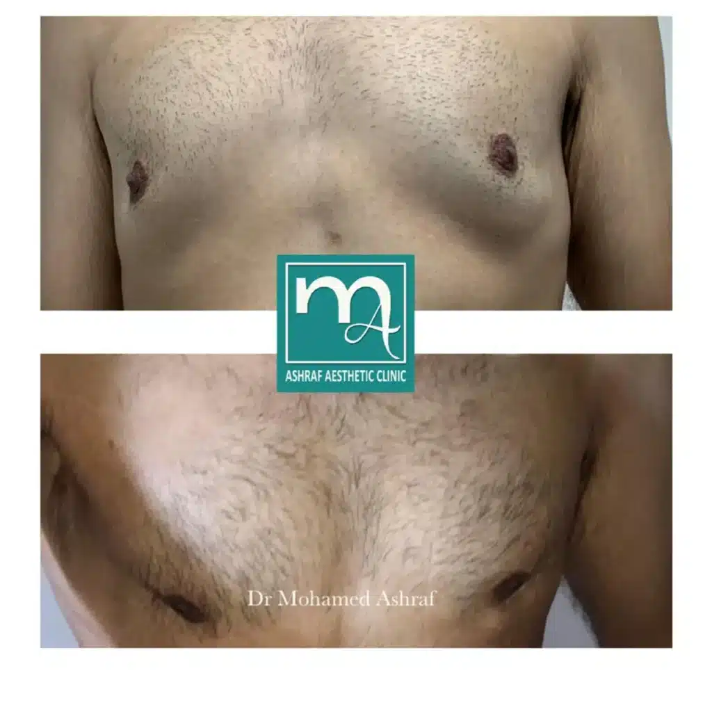 Gynecomastia treated with Vaser liposuction