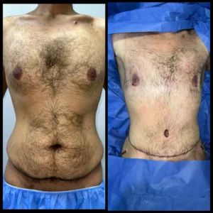 شكل جرح شد البطن الحزامي