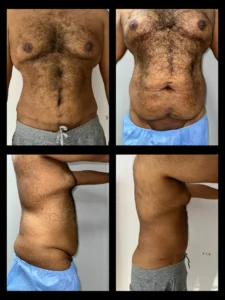 شد البطن الجراحي قبل و بعد للرجال