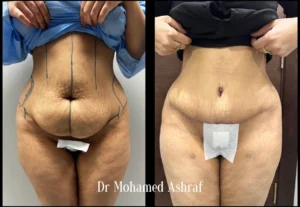 شد البطن بعد الولادة