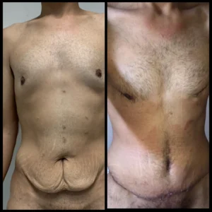 شد البطن قبل و بعد